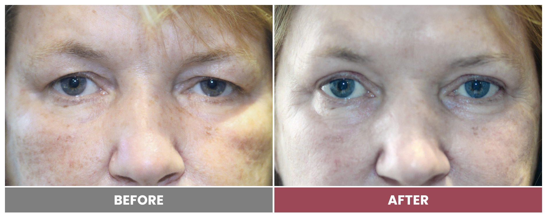 Upper Blepharoplasty - Case 107